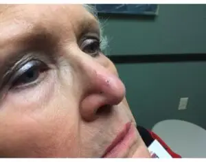 Mohs on the Right Nasal Tip with Reconstruction