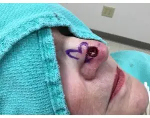 Mohs on the Right Nasal Tip with Reconstruction