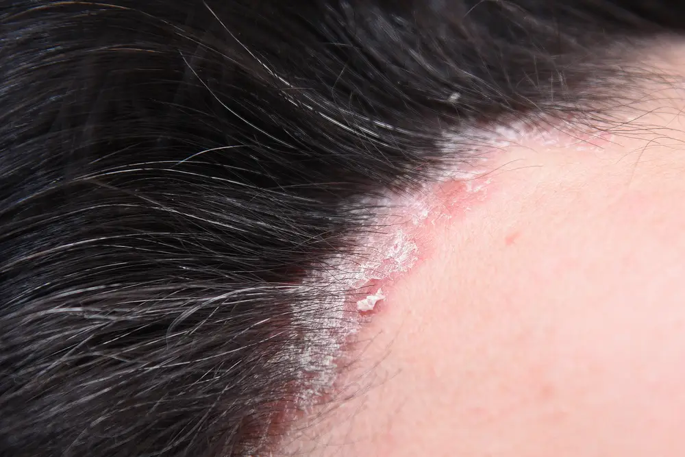 Psoriasis. Hairy part of the head