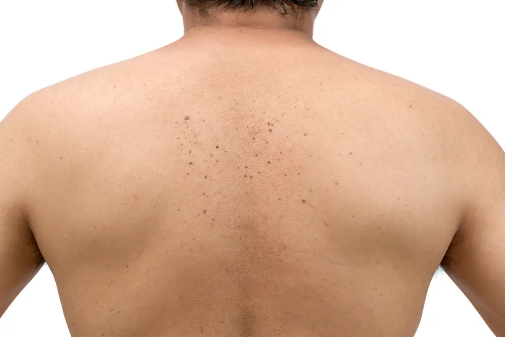 Skin tags or Seborrheic Keratosis on back