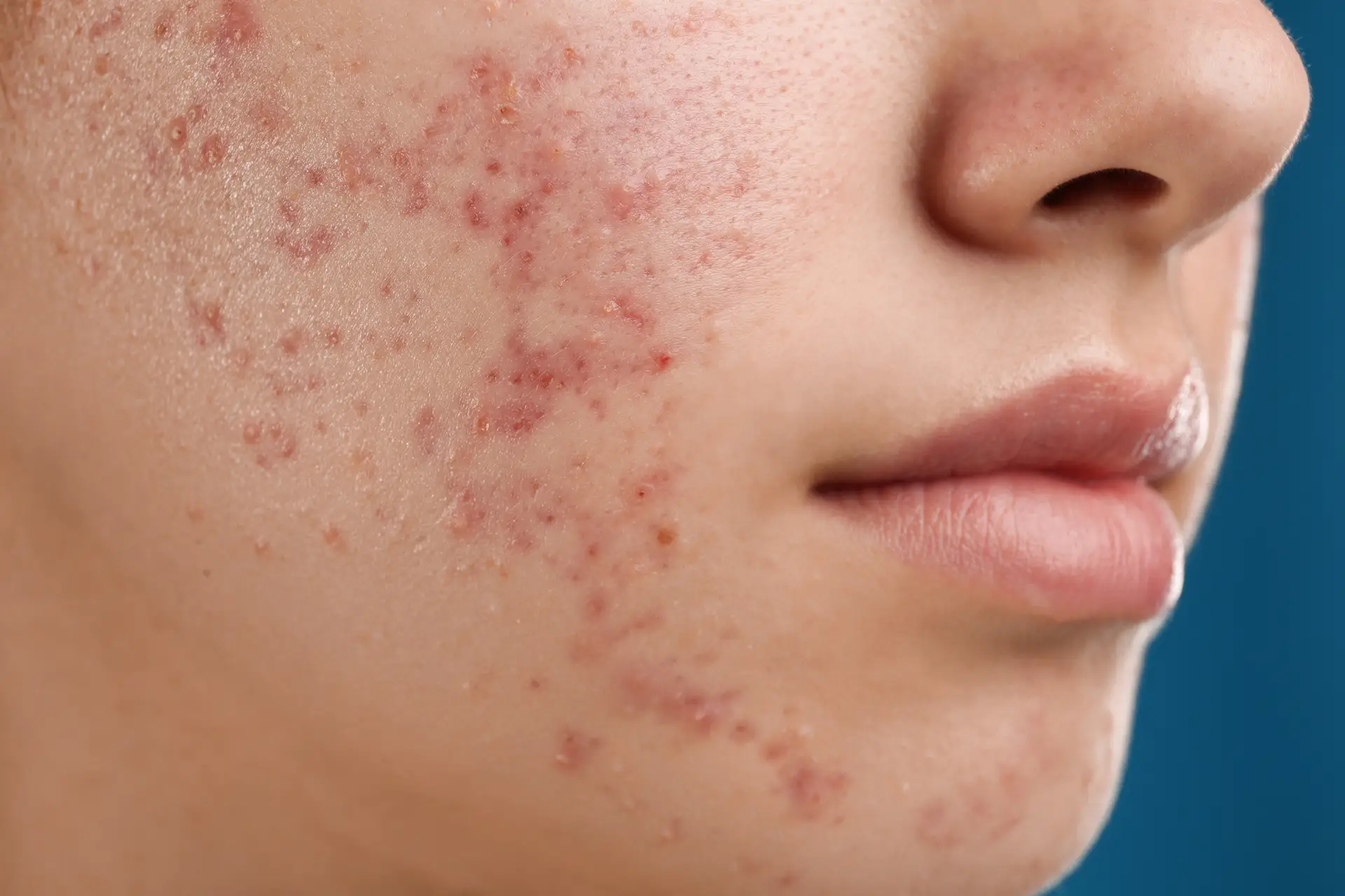 Teenage girl with acne problem