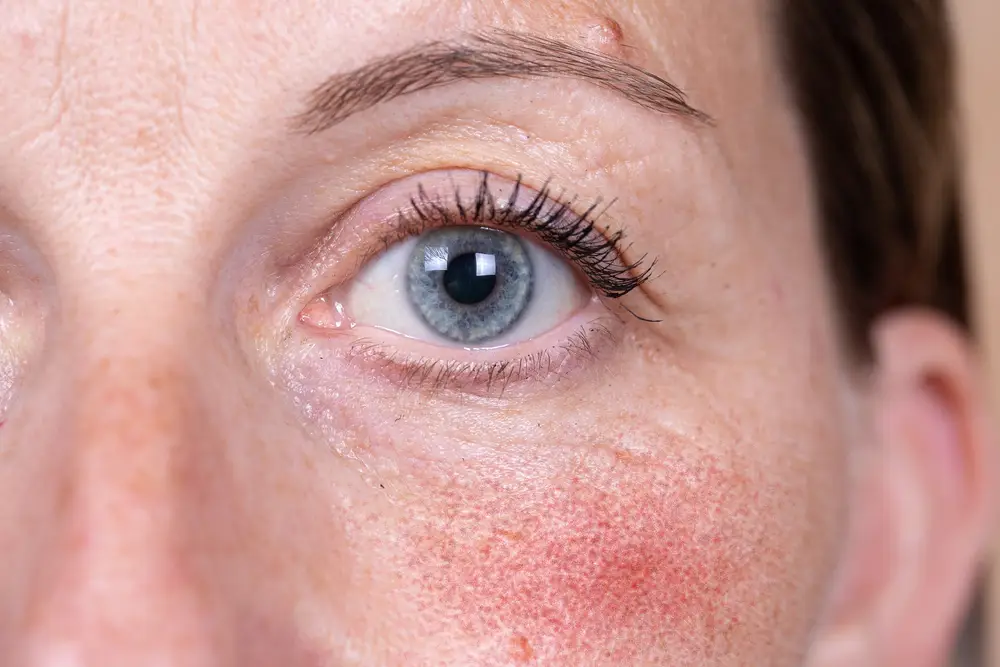 severe rosacea in the cheek