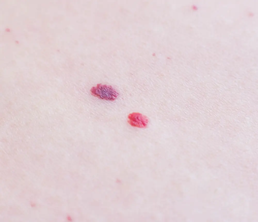 Two red moles on the patient s skin, hemangioma, macro