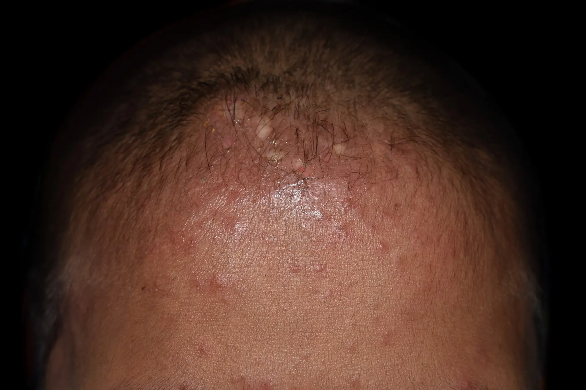 Small skin lesions on forehead