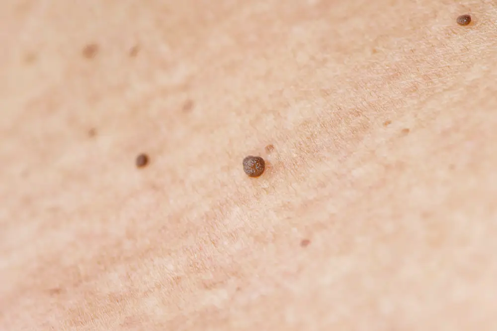 Warts - Skin Tag Disease