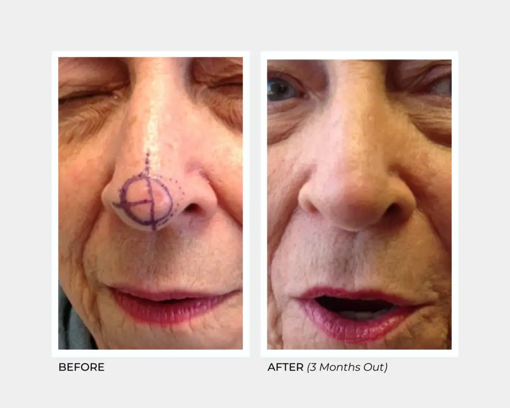 Mohs Cheek Interpolation Flap on the Nose