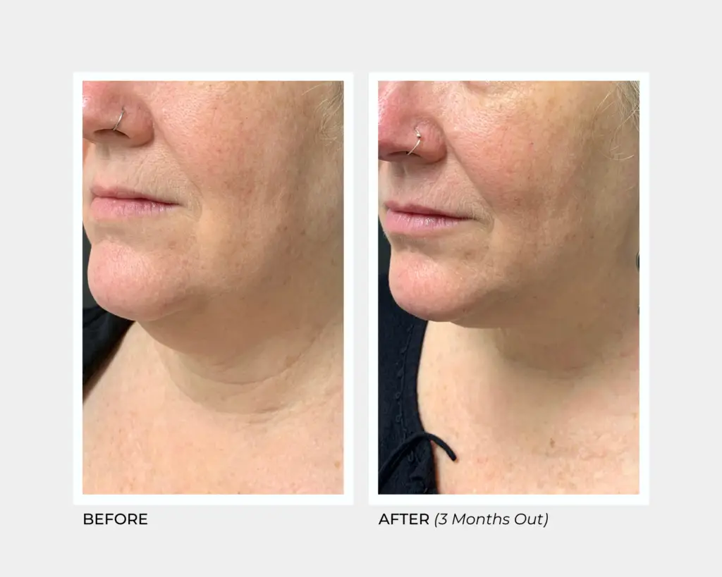 Ultherapy on the Lower Face and Full Neck