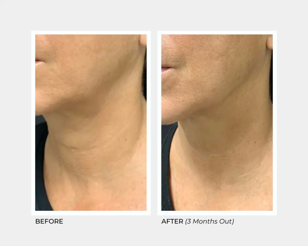 Ultherapy on the Neck