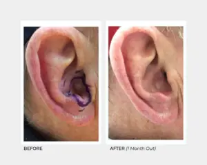 Brachytherapy on the Ear