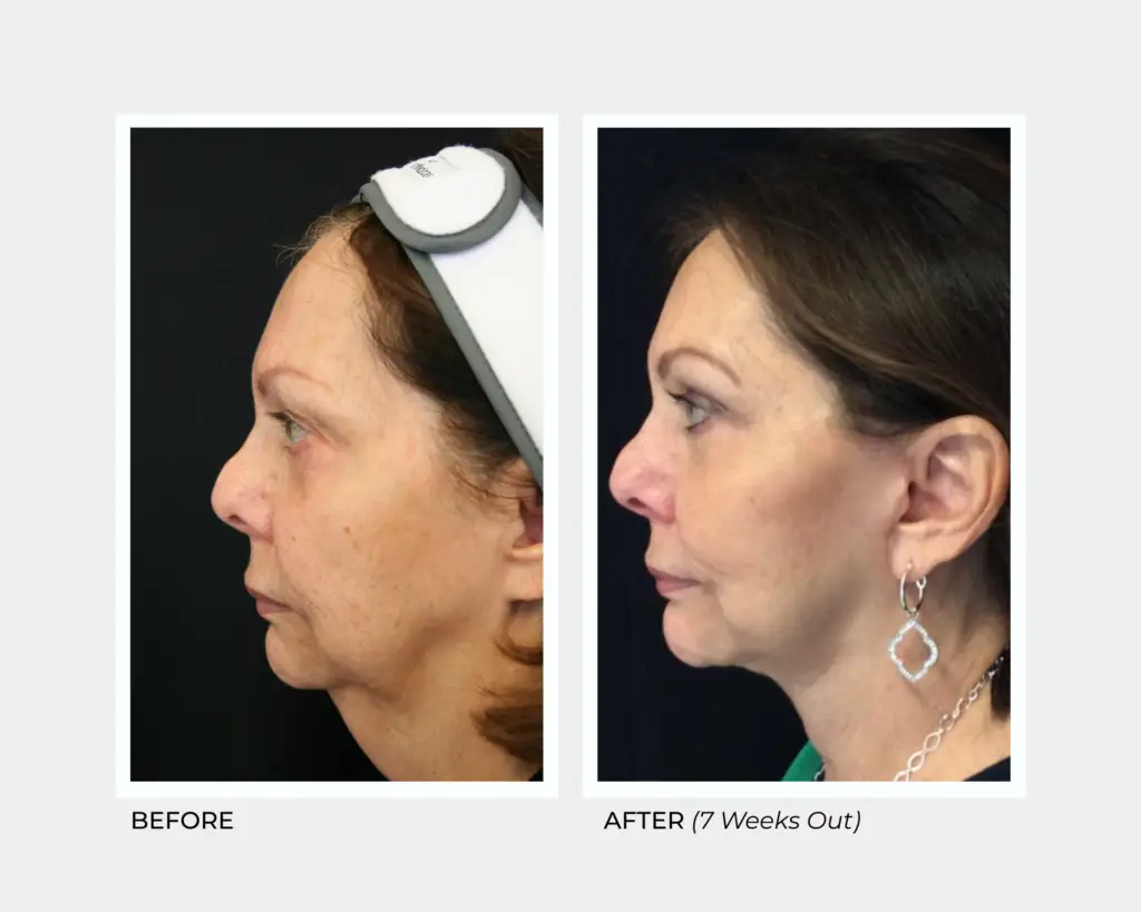 Vertical Vector Face and Neck Lift
