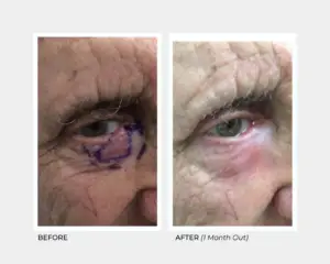 Brachytherapy on the Eyelid