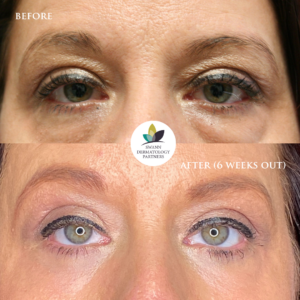 Lower Blepharoplasty (Lower Eyelid Lift)