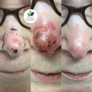 Brachytherapy on the Nose