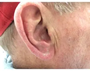 Brachytherapy on the Ear