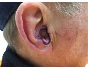 Brachytherapy on the Ear