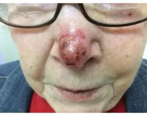 Brachytherapy on the Nose