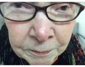 Brachytherapy on the Nose
