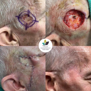 Melanoma
