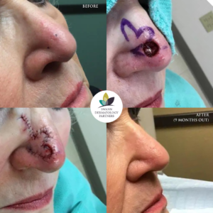 mohs before and after