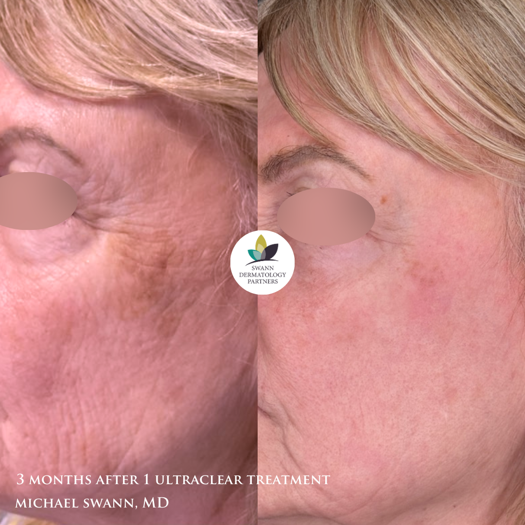 UltraClear laser before and after on the cheek and under-eye area, 3 months after one treatment by Michael Swann, MD