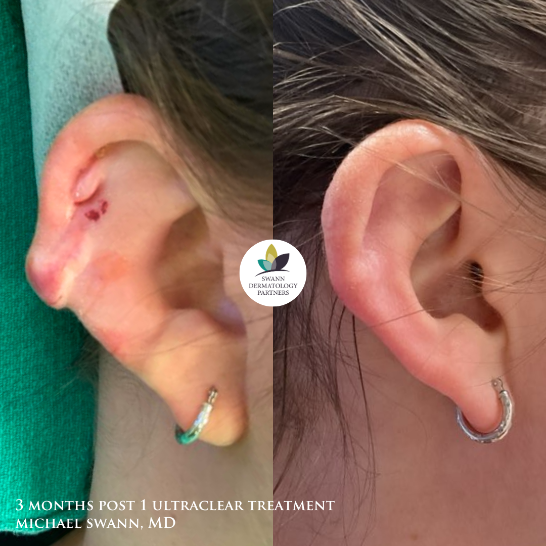 UltraClear laser before and after of a keloid on the ear, 3 months after one treatment by Michael Swann, MD
