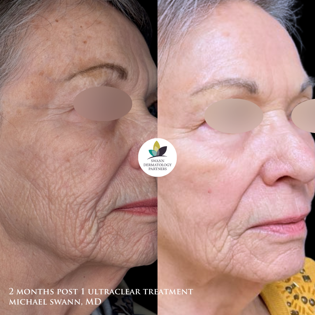 UltraClear laser before and after on facial wrinkles, 2 months after one treatment by Michael Swann, MD