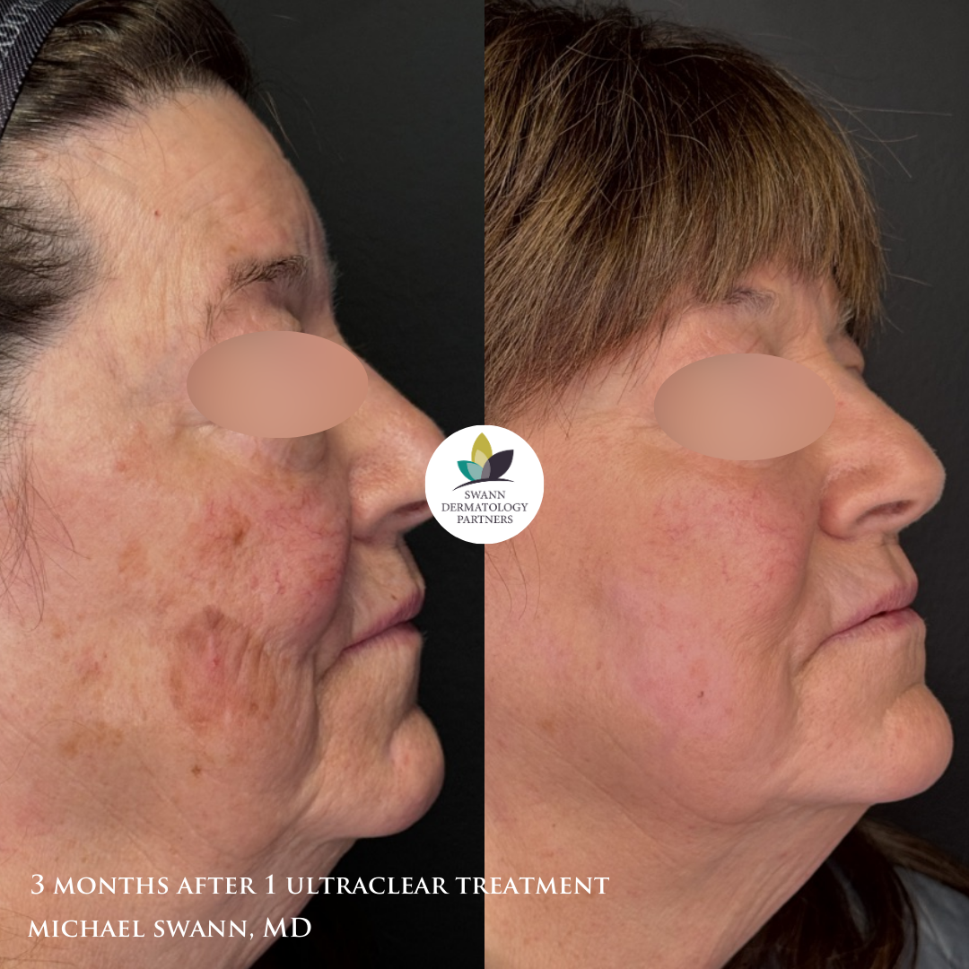 UltraClear laser before and after on the cheek, 3 months after one treatment by Michael Swann, MD