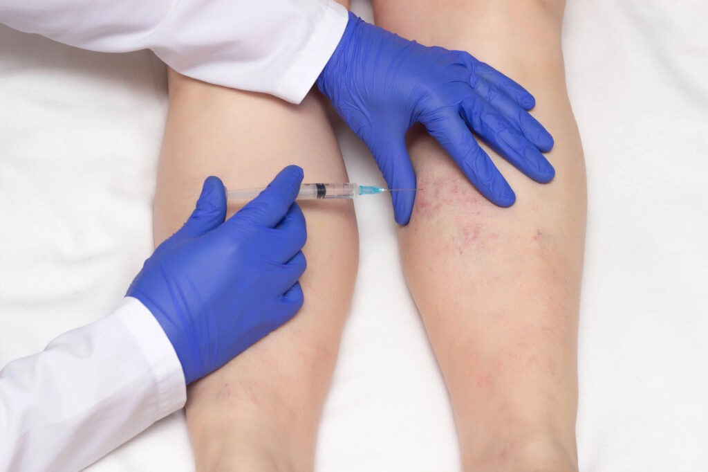 Doctor-in-medical-gloves-injects-sclerotherapy-procedure