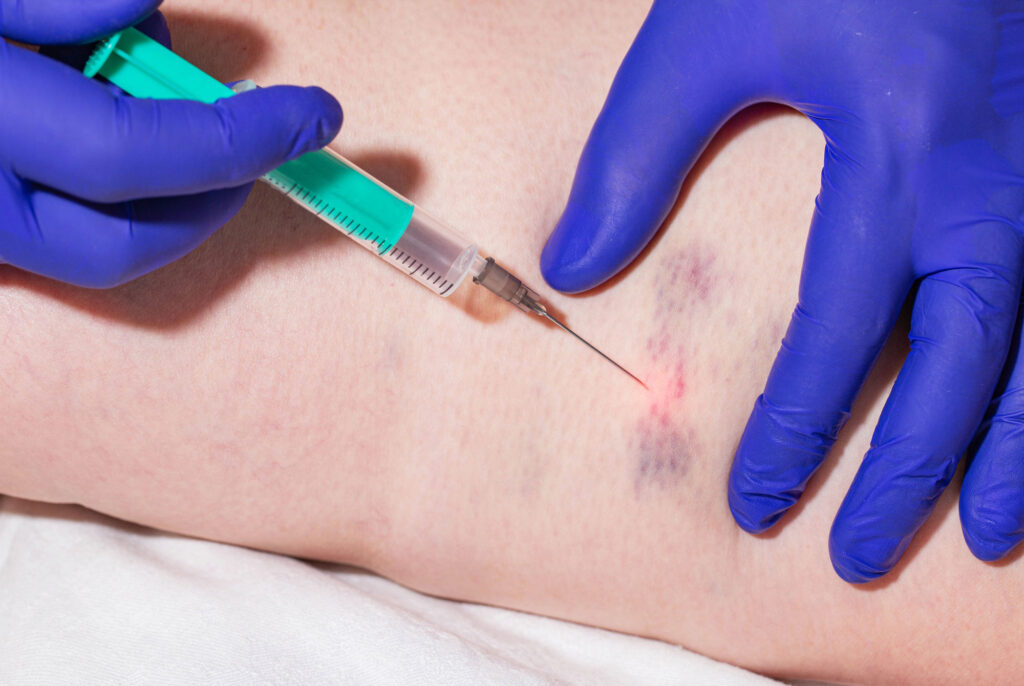 Doctor-makes-sclerotherapy-injection-into-patients-damaged-veins