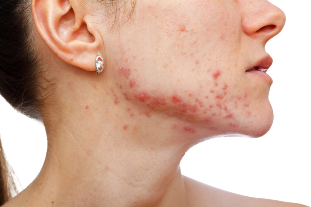 Young-girl-with-skin-problem