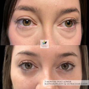 Lower Blepharoplasty + UltraClear Laser