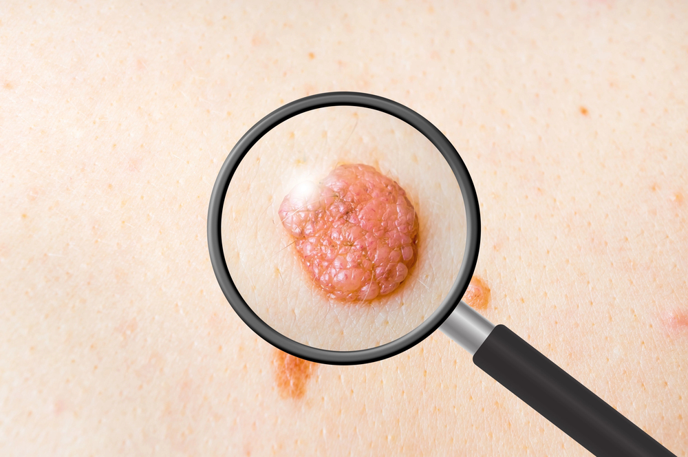 Dermatologist doctor examines a birthmark of patient
