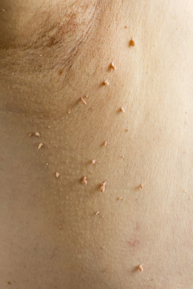 Papilloma virus in the human armpit