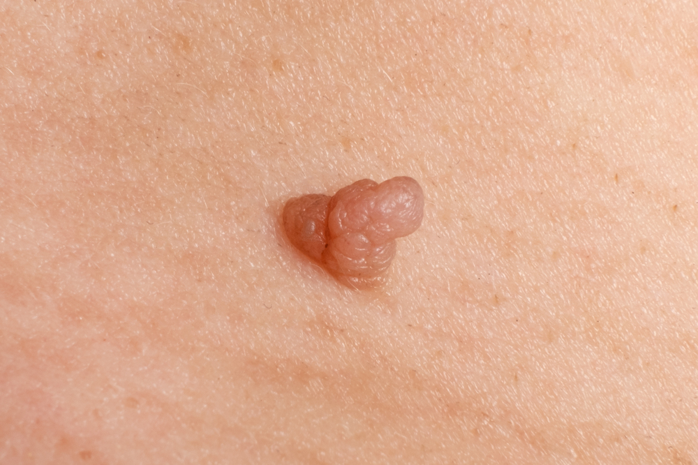 Cancer papilloma on the skin, wart close up