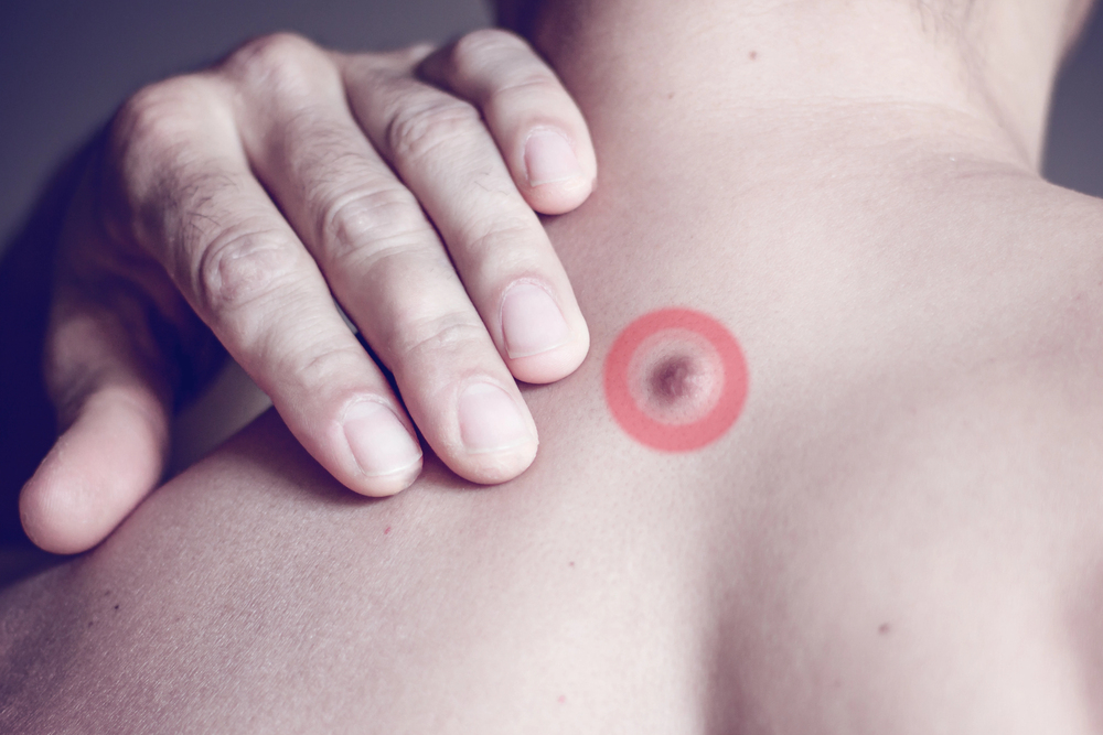 Fibroma on the male back, details, close-up