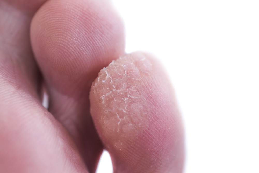 A case of verruca or plantar warts on the bottom of the small toe.