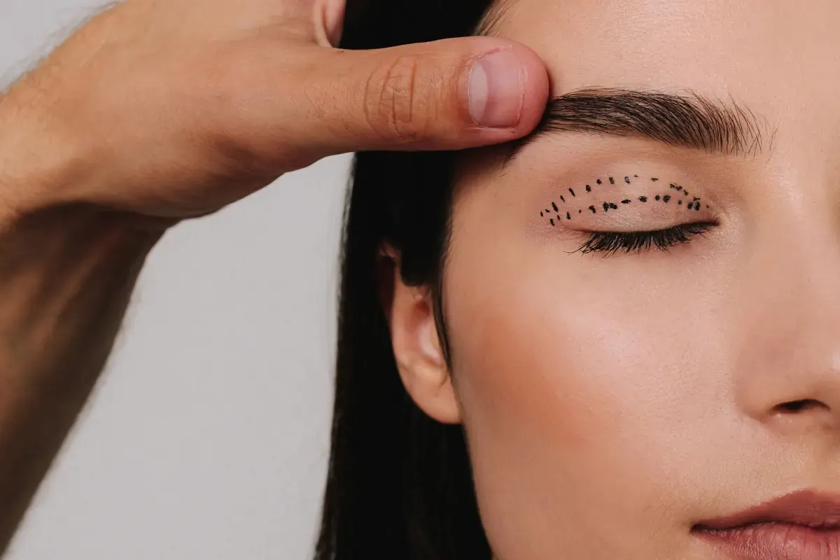 Blepharoplasty