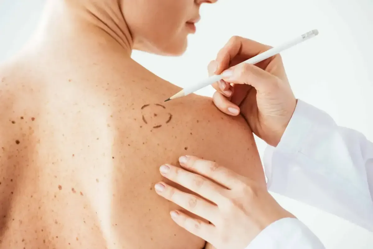 dermatologist applying marks